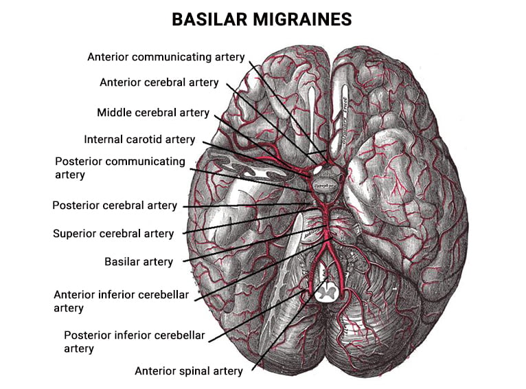 Basilar Migraines