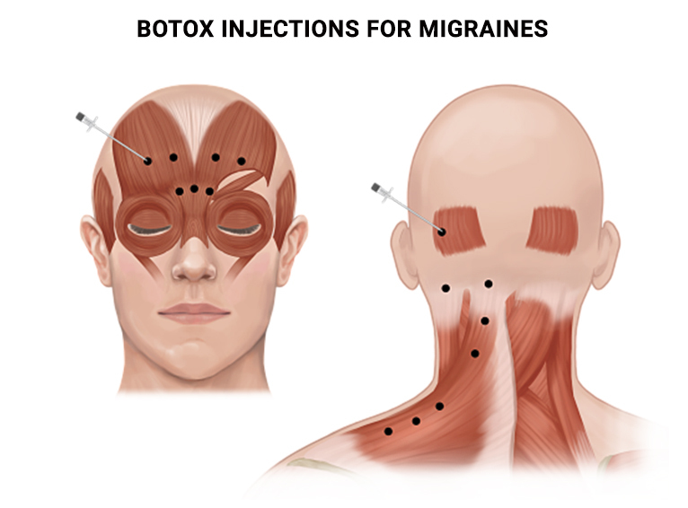 Botox Injections for Migraines Pain Relief in Manhattan, NYC & NJ