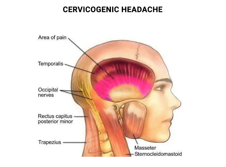 Cervicogenic headache