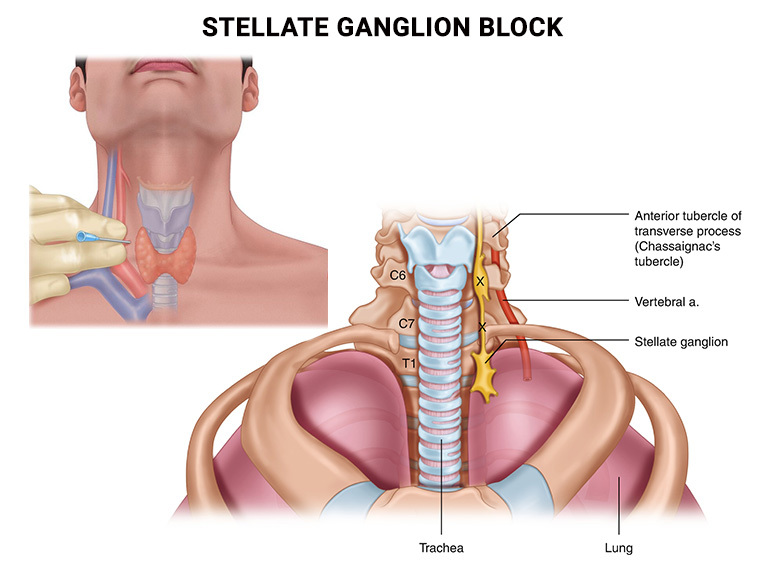Stellate Ganglion Block