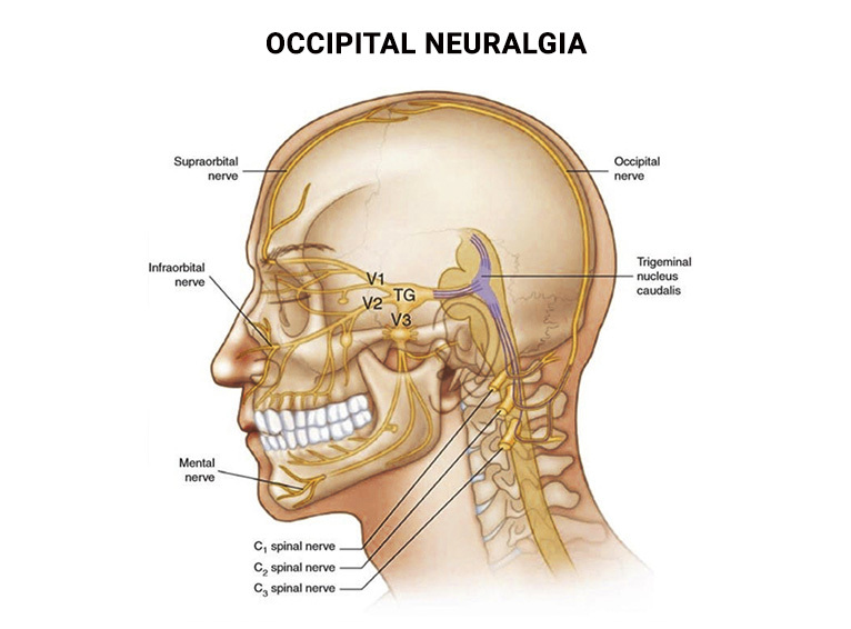 Occipital Neuralgiain Nyc And Nj Advanced Headache Center 9627