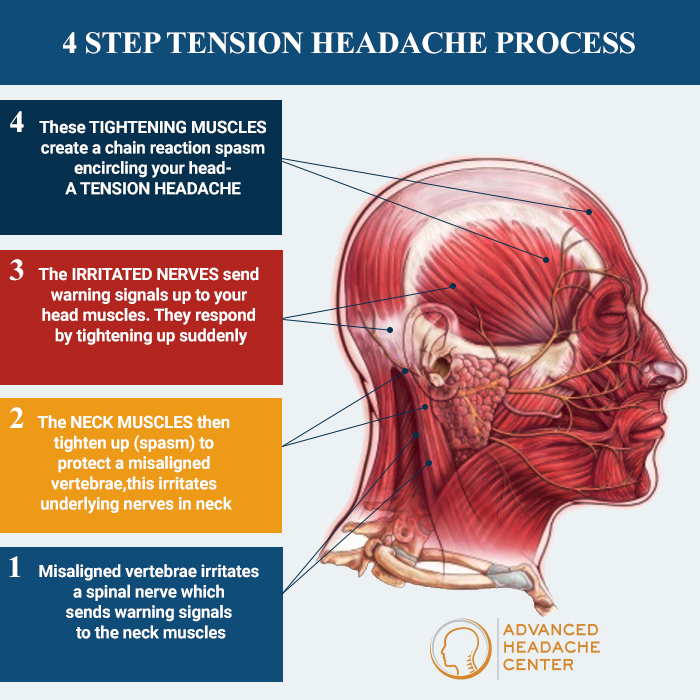 4 step tension Headache Process