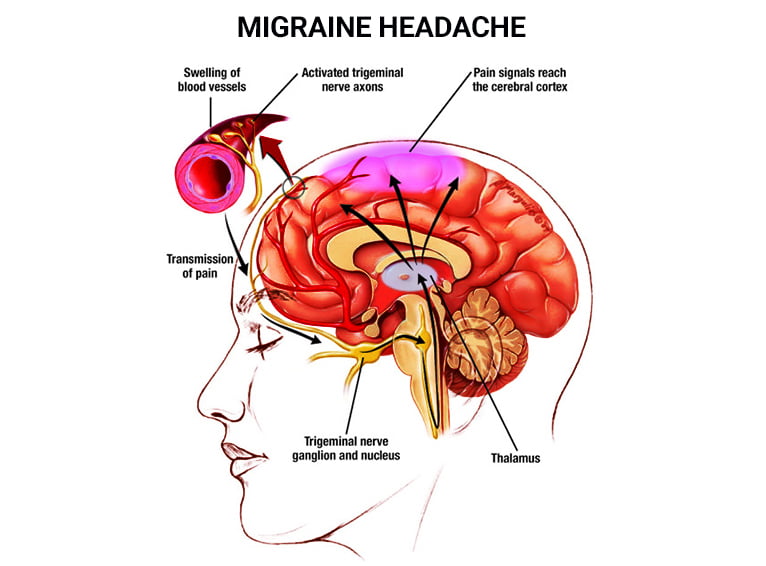 what causes headaches on the left back side of the head