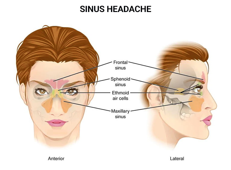 Sinus Headache